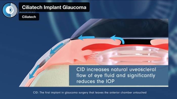 biotech info articles ciliatech implant glaucoma 
